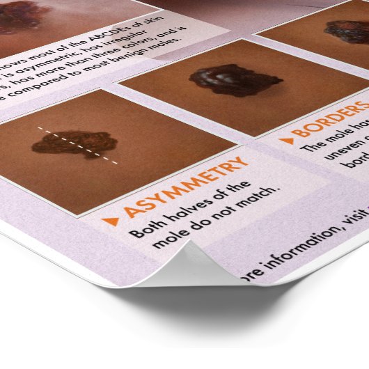 Melalogisch melanoom medisch Poster (Hoek)