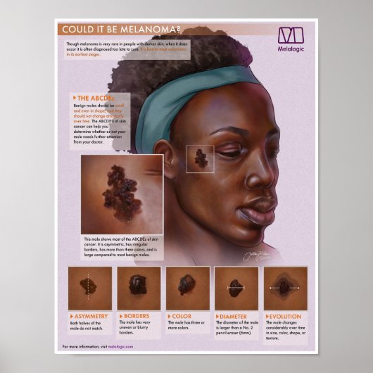 Melalogisch melanoom medisch Poster (Voorkant)