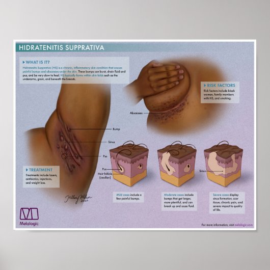 Melalogische hidradenitis supprativa medisch Poste Poster (Voorkant)