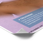 Melalogische hyperpigmentatie Medisch Poster (Hoek)