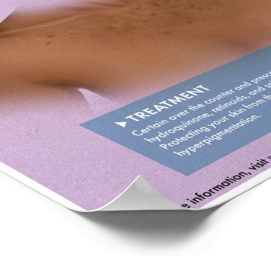 Melalogische hyperpigmentatie Medisch Poster (Hoek)