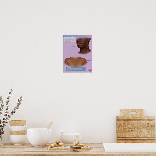 Melalogische hyperpigmentatie Medisch Poster (Keuken)