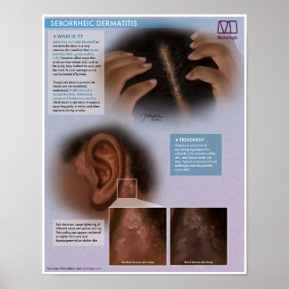 Melalogische seborrheic dermatitis (roos) Medisch Poster