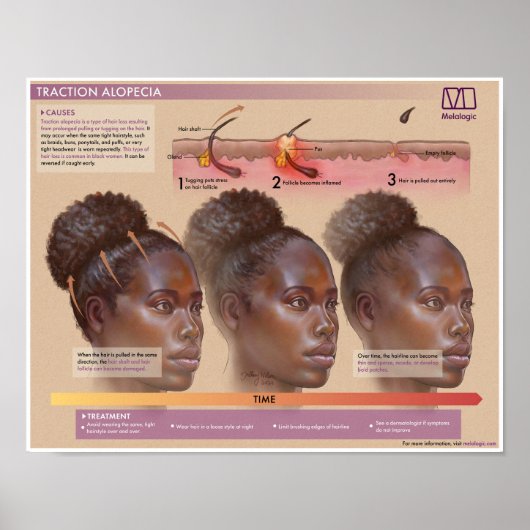 Melalogische tractie Alopecia Medisch Poster (Voorkant)
