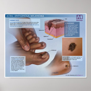 Melologisch Acraal Lentigineus Melanoom Medische P Poster