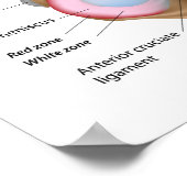 Menisci van het knie-Poster Poster (Hoek)