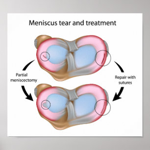 Meniscus scheur en Poster voor chirurgie