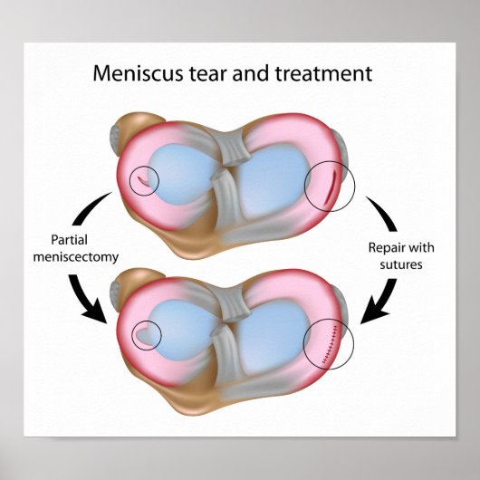 Meniscus scheur en Poster voor chirurgie (Voorkant)