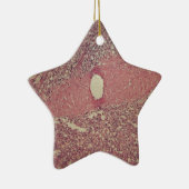 Menselijke milt met chronische myeloïde leukemie keramisch ornament (Rechts)