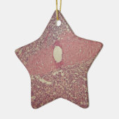 Menselijke milt met chronische myeloïde leukemie keramisch ornament (Links)