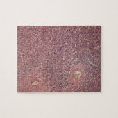 Menselijke milt met chronische myeloïde leukemie legpuzzel (Horizontaal)