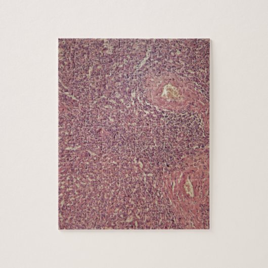 Menselijke milt met chronische myeloïde leukemie legpuzzel (Verticaal)