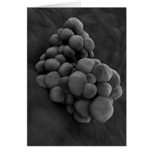 Microscopisch Uitzicht van tumor 1