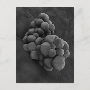 Microscopisch Uitzicht van tumor 1 Briefkaart