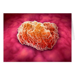 Microscopisch Uitzicht van tumor 3