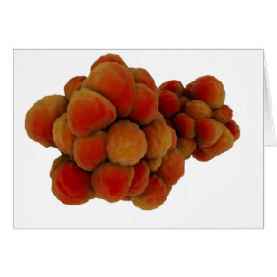 Microscopisch Uitzicht van tumor 4