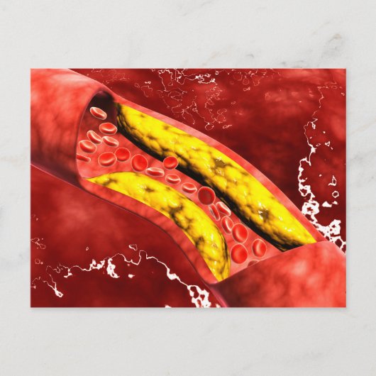 Microscopisch Uitzicht van vetplak in de slagader Briefkaart (Voorkant)