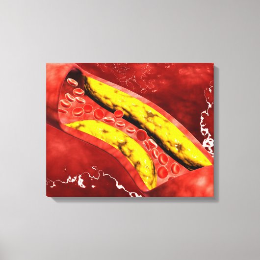 Microscopisch Uitzicht van vetplak in de slagader Canvas Afdruk (Voorkant)