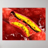 Microscopisch Uitzicht van vetplak in de slagader