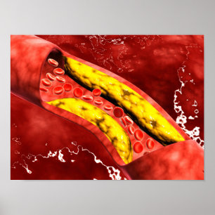 Microscopisch Uitzicht van vetplak in de slagader Poster