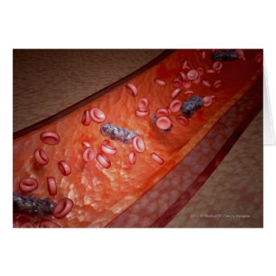 Microscopische weergave van een bloedinfectie