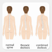 Misvorming wervelkolom vierkante sticker (Voorkant)