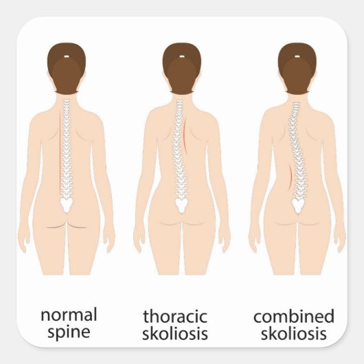 Misvorming wervelkolom vierkante sticker (Voorkant)