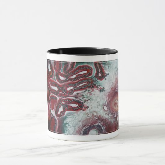 mok koffie! "Malignant Struma Ovarii" (Midden)