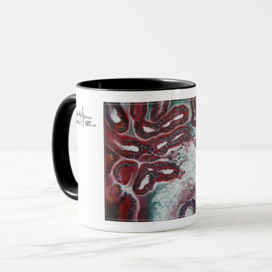 mok koffie! "Malignant Struma Ovarii" (Voorkant links)