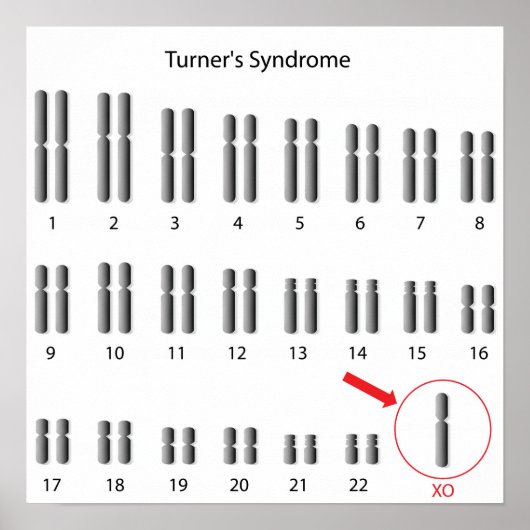 Monosomy X, Turner's syndrome Poster (Voorkant)