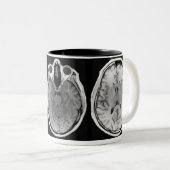 MRI afbeelding mok (Voorkant rechts)