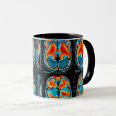 MRI hersenscan Mok (Voorkant rechts)