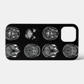 MRI-scan van Brain Case-Mate iPhone Case (Achterkant (horizontaal))