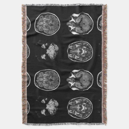 MRI-scan van Brain Deken (Voorkant Verticaal)