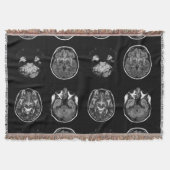 MRI-scan van Brain Deken (Voorkant)