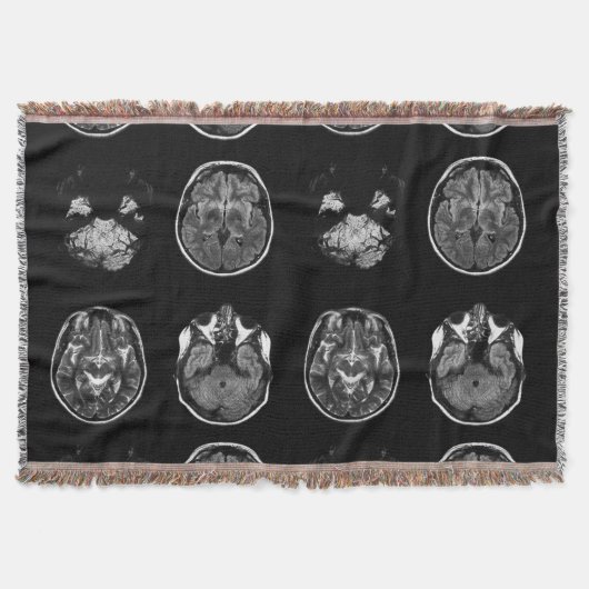 MRI-scan van Brain Deken (Voorkant)