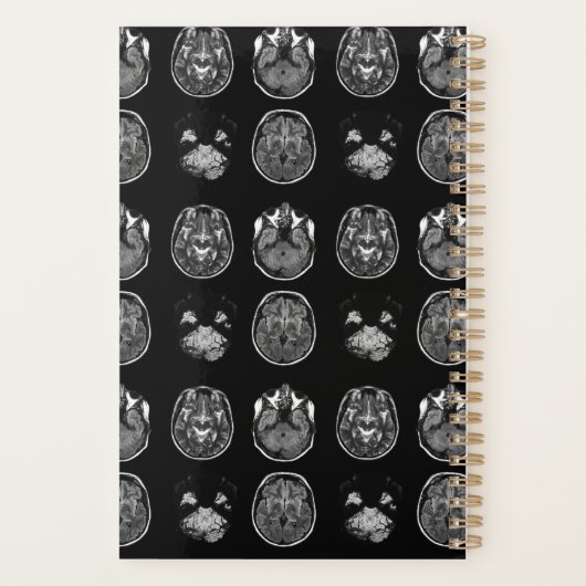 MRI-scan van Brain Planner (Achterkant)
