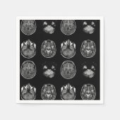 MRI-scan van Brain Servet (Voorkant)