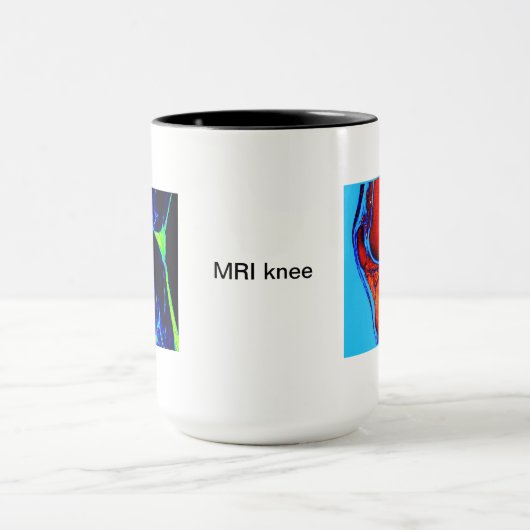 MRI van knie Mok (Midden)