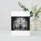 MRI voor hersenen, coronaal segment Briefkaart (Staand voorkant)