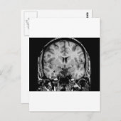 MRI voor hersenen, coronaal segment Briefkaart (Voorkant / Achterkant)