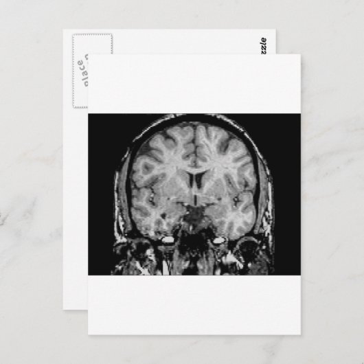 MRI voor hersenen, coronaal segment Briefkaart (Voorkant / Achterkant)