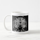 MRI voor hersenen, coronaal segment Koffiemok (Links)