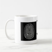 multipele sclerose koffiemok (Links)