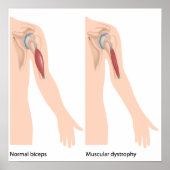 Musculair dystrofie Poster (Voorkant)