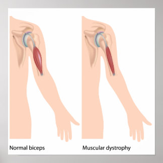 Musculair dystrofie Poster