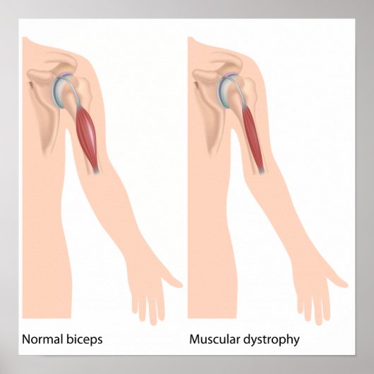 Musculair dystrofie Poster (Voorkant)