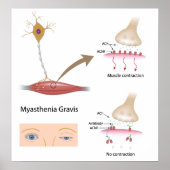 Myasthenia Gravis eye Poster (Voorkant)