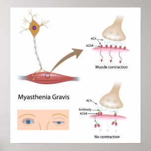 Myasthenia Gravis eye Poster