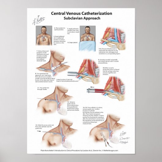 Netter Chart: Central Venous Catheterization Poster (Voorkant)